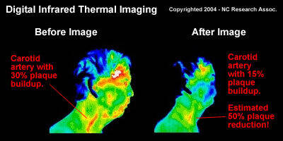 image_carotid_artery_infrared_thermal